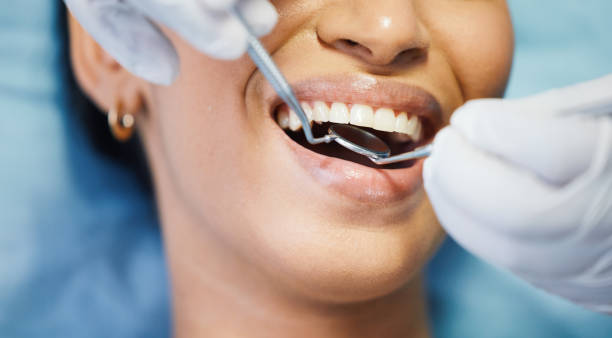Best Emergency Dentist for Lost Fillings or Crowns in Cleveland, AL