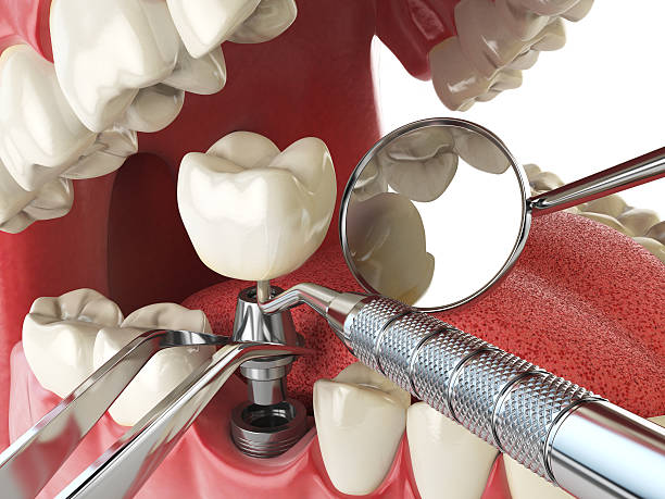 Best Emergency Root Canal Treatment in Cleveland, AL